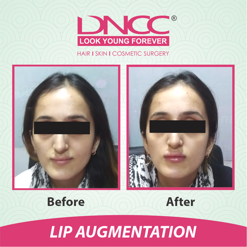 Hair Transplant Transformation 1